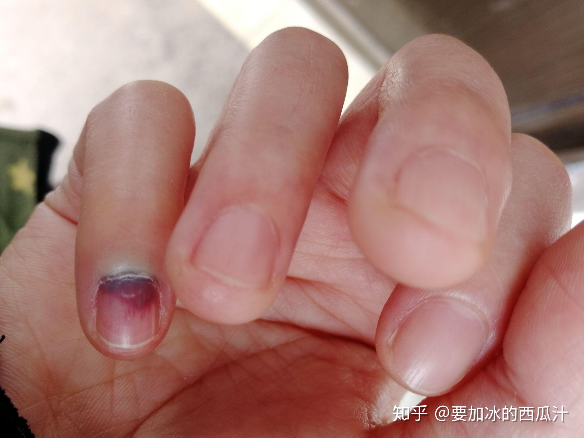 手指被门夹肿还夹出淤血是什么感受? - 知乎