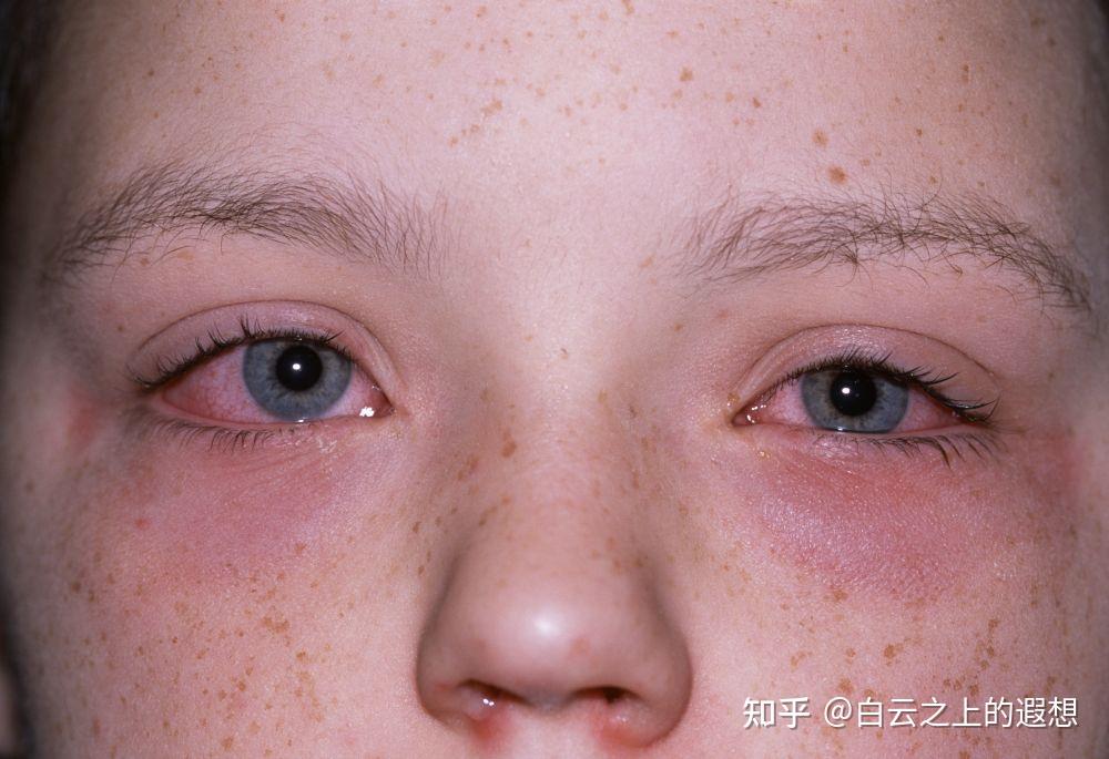 过敏性结膜炎如何治疗 - 知乎