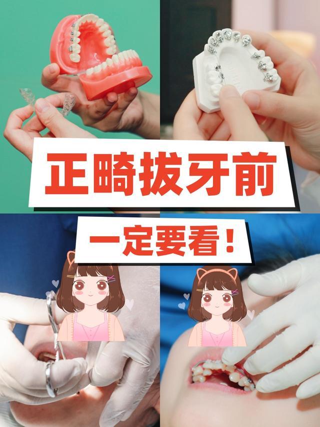 疼不疼?拔牙矫正对医生有什么要求?拔牙矫正后需要注意什么?