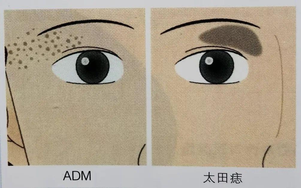 斑斑点点，傻傻分不清楚？褐青色痣和黄褐斑如何区分 | 北京崇文门分院李艳医生 - 知乎