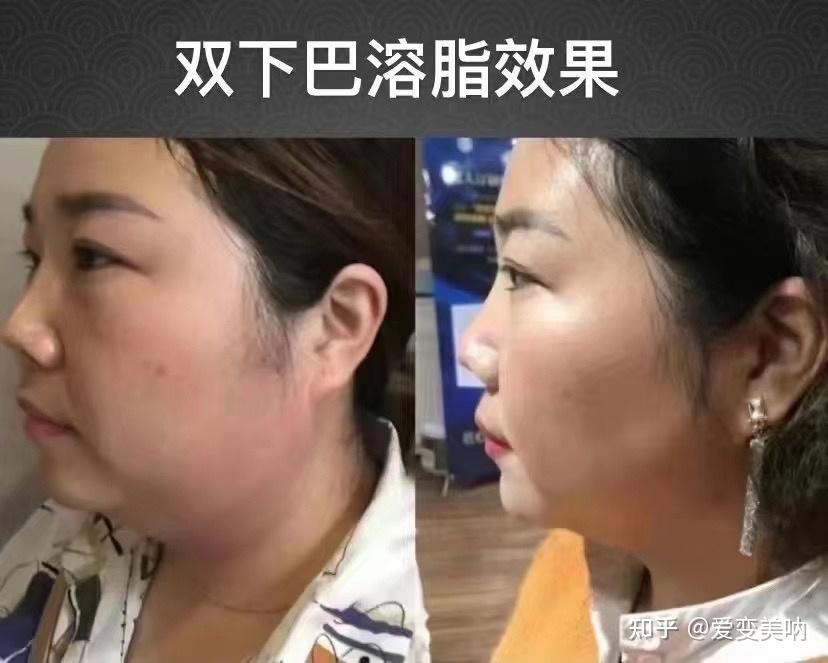 蜜拉贝儿溶脂针是骗子吗? - 知乎