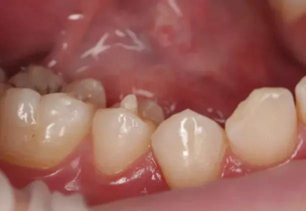 怎么处理畸形中央尖