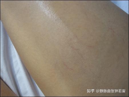 女生腿上有网状红血丝是怎么回事,该怎么改善? - 知乎