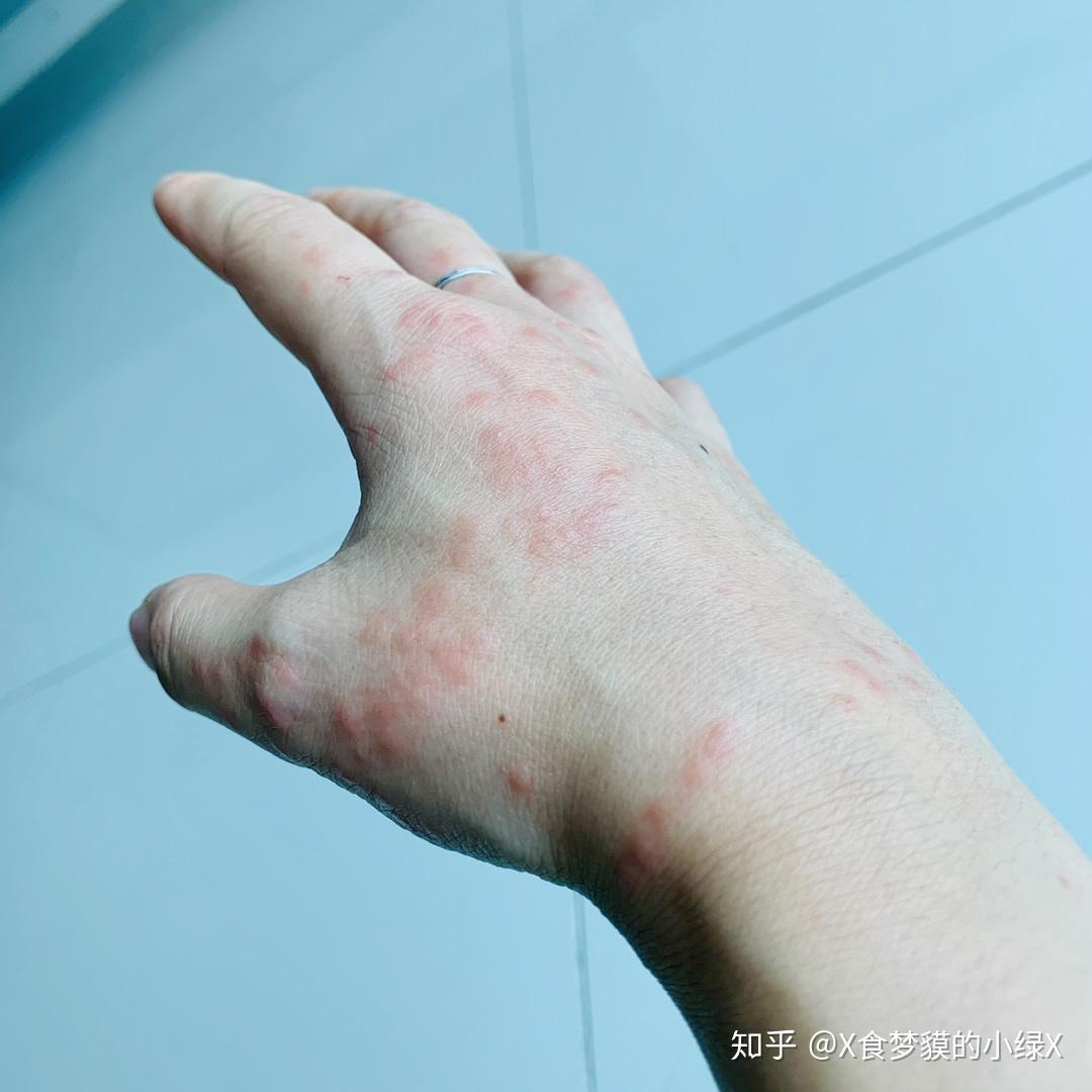 被水母蛰是一种什么体验