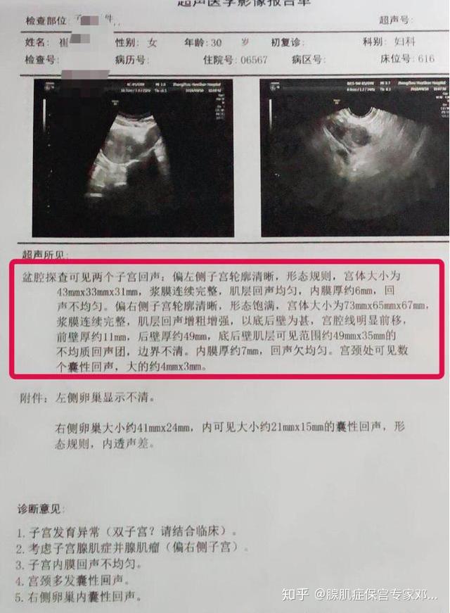 「罕见」双子宫腺肌症患者，痛经要承受双倍吗？ - 知乎