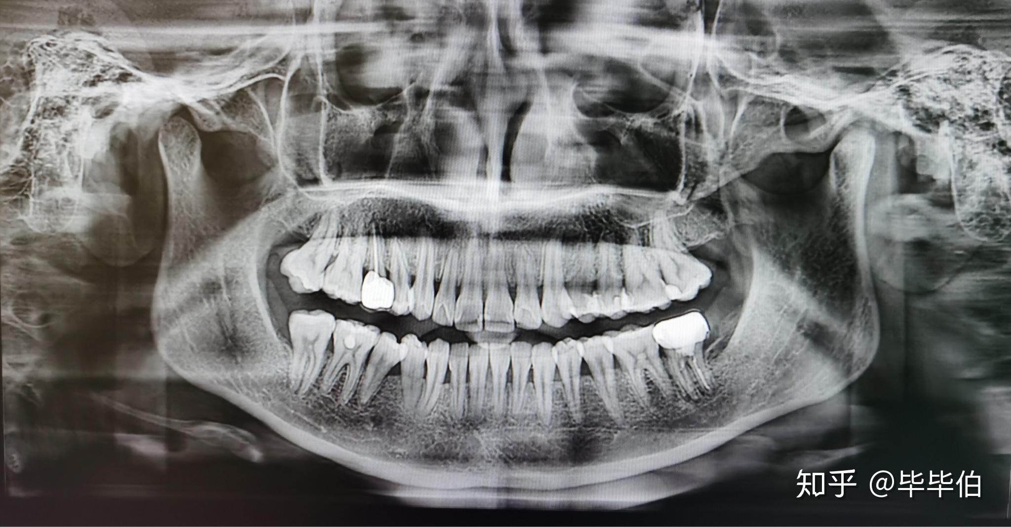 满口蛀牙补了很多牙是种怎样的体验? - 知乎
