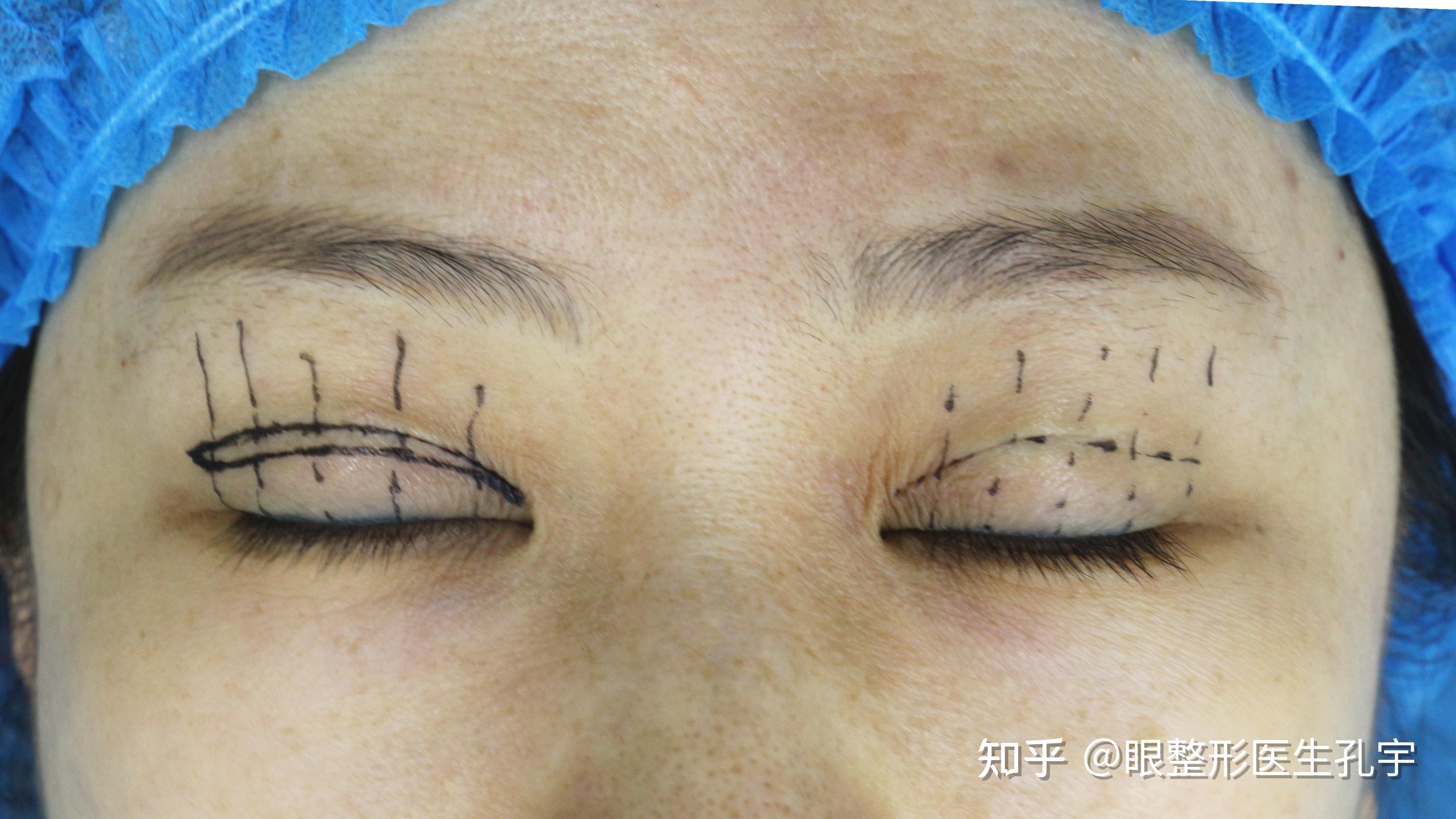 甲状腺眼病导致的上眼睑退缩如何改善? - 知乎