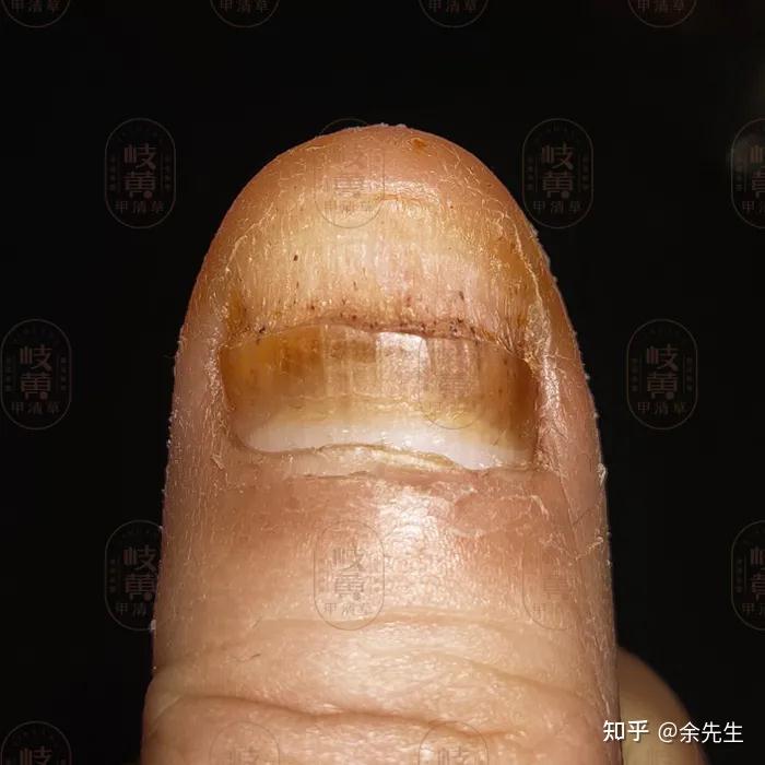 左脚小拇指指甲变黄变厚好像两层的感觉好像是穿了一次挤脚的鞋之后