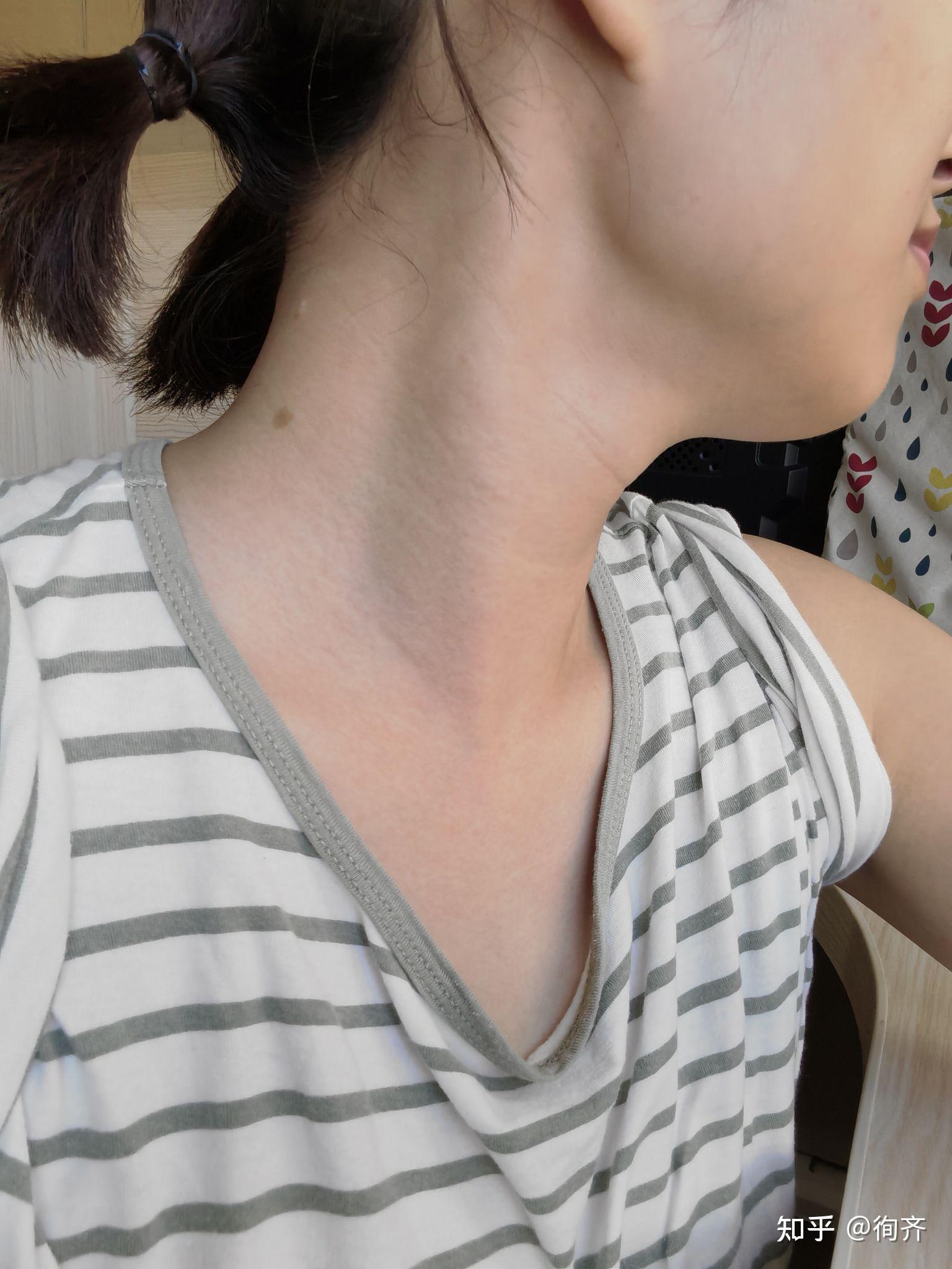 甲亢如何使脖子变正常