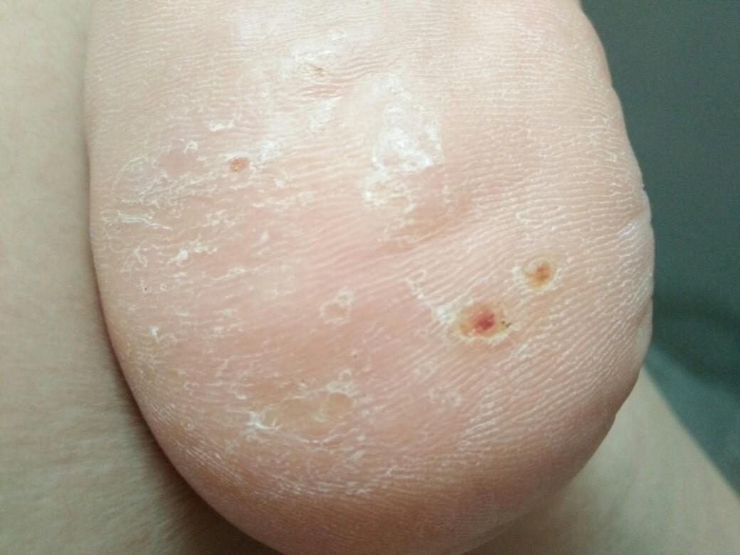 脚后跟长了很多的疣看了很久的医生做过冷冻也泡过中药又是打针又是