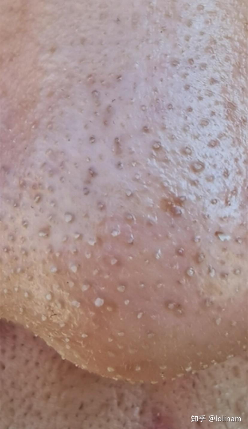 鼻子有黑头且毛孔粗大坑坑洼洼,应该怎么办? - 知乎