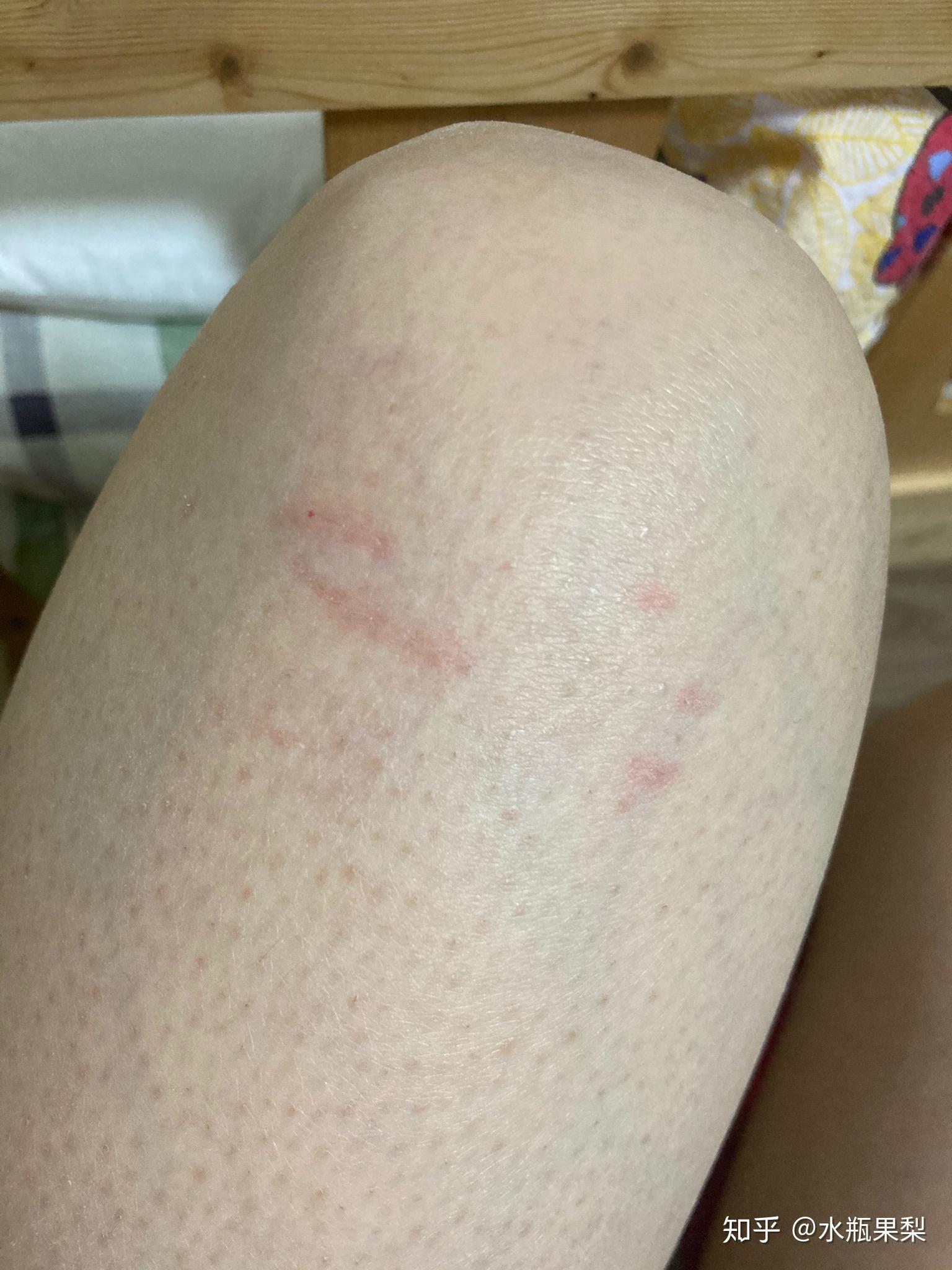 被自己养的猫咪抓伤了破皮了该怎么处理