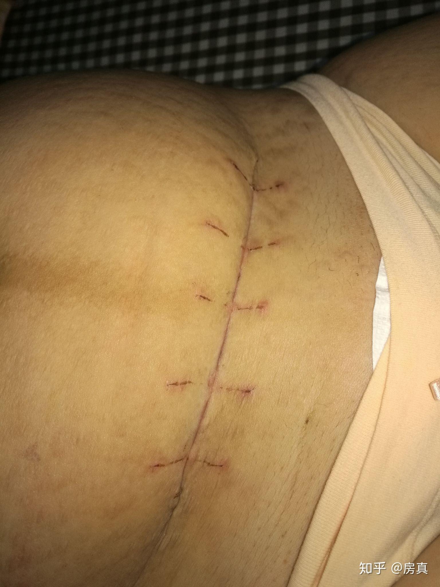 剖腹产10天伤口图片图片