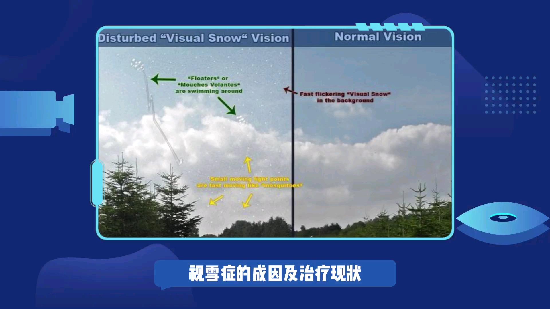 视雪症如何治疗? - 知乎
