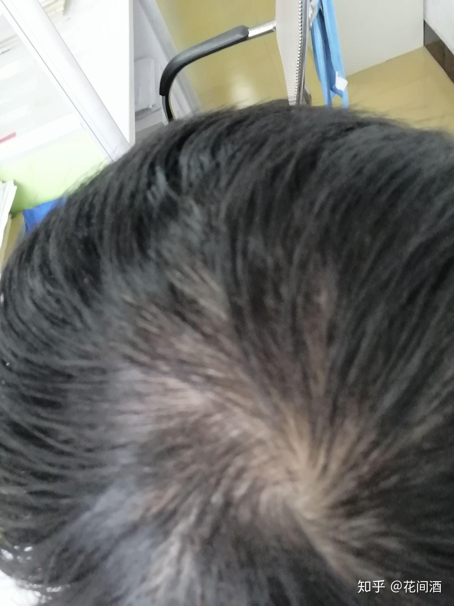 女生头旋这样是不是要秃