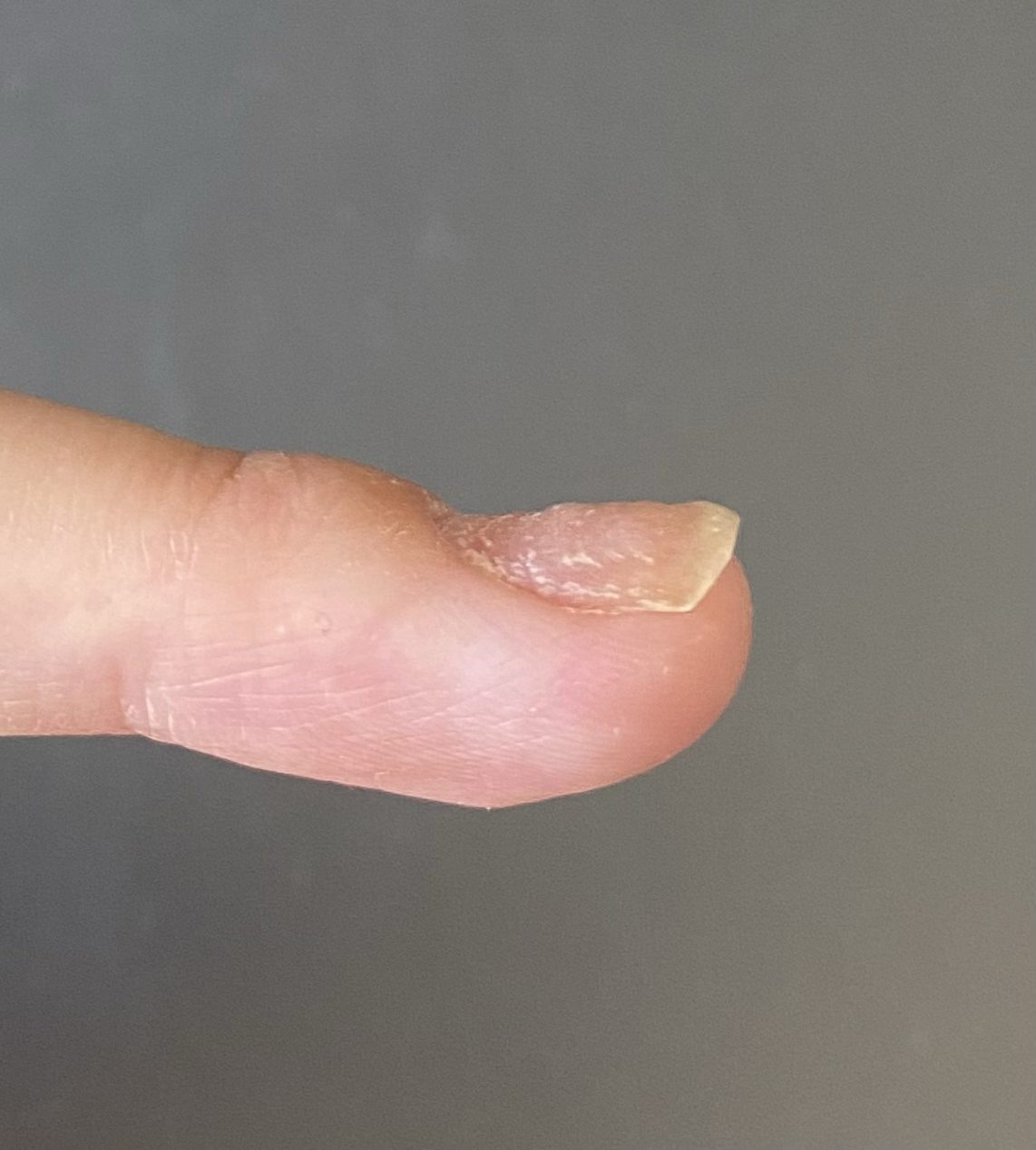 指甲上凹凸不平,横向上一条条的,是缺钙吗? - 知乎