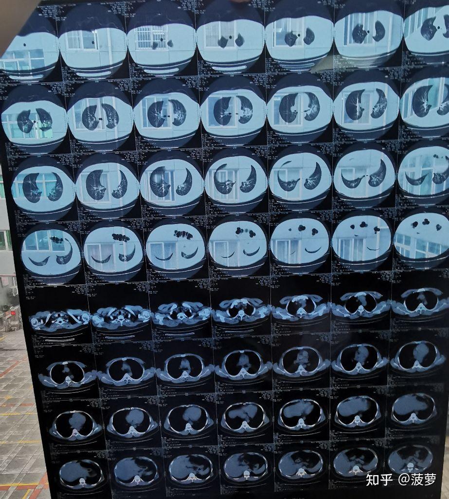 肺部ct 检查需求暴增,专家称「肺炎实际检出率约10%-20%」,何时需照