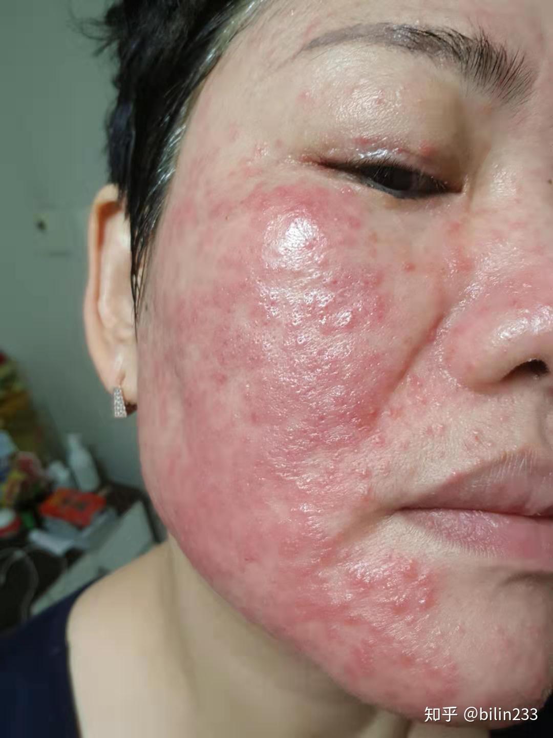 为了治好过敏肌你都做过什么? - 知乎