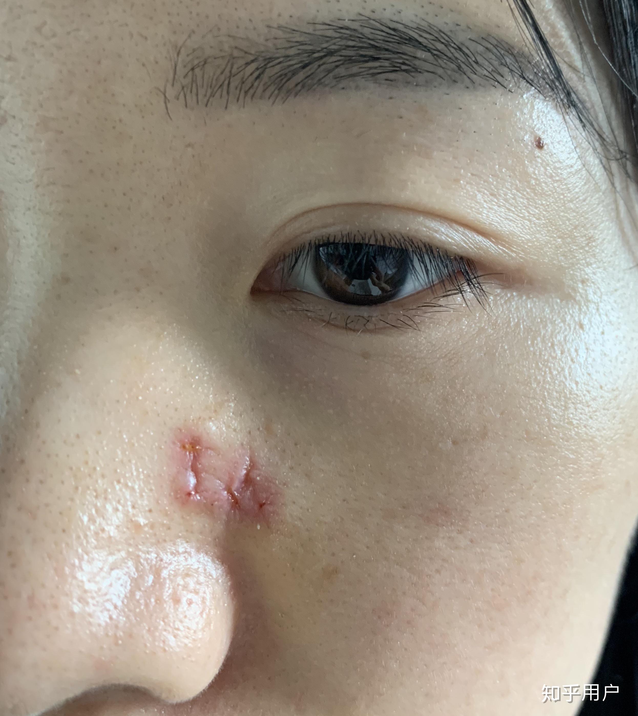 手术切痣是一种怎样的体验