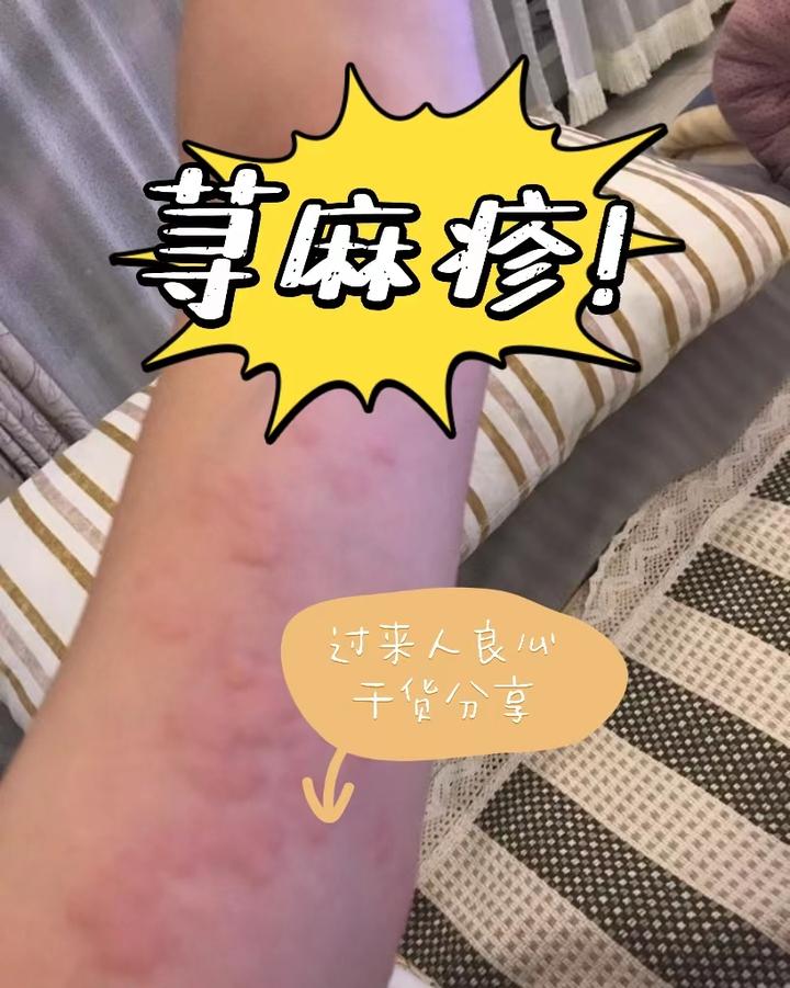 维生素加一物轻松消疹止痒？！荨麻疹朋友一定不要错过！ 知乎