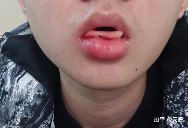 请问口腔里粘液腺囊肿是不是有必要做手术切除一开始就有蚕豆那么大