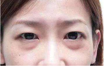 一 ,眼部凹陷
