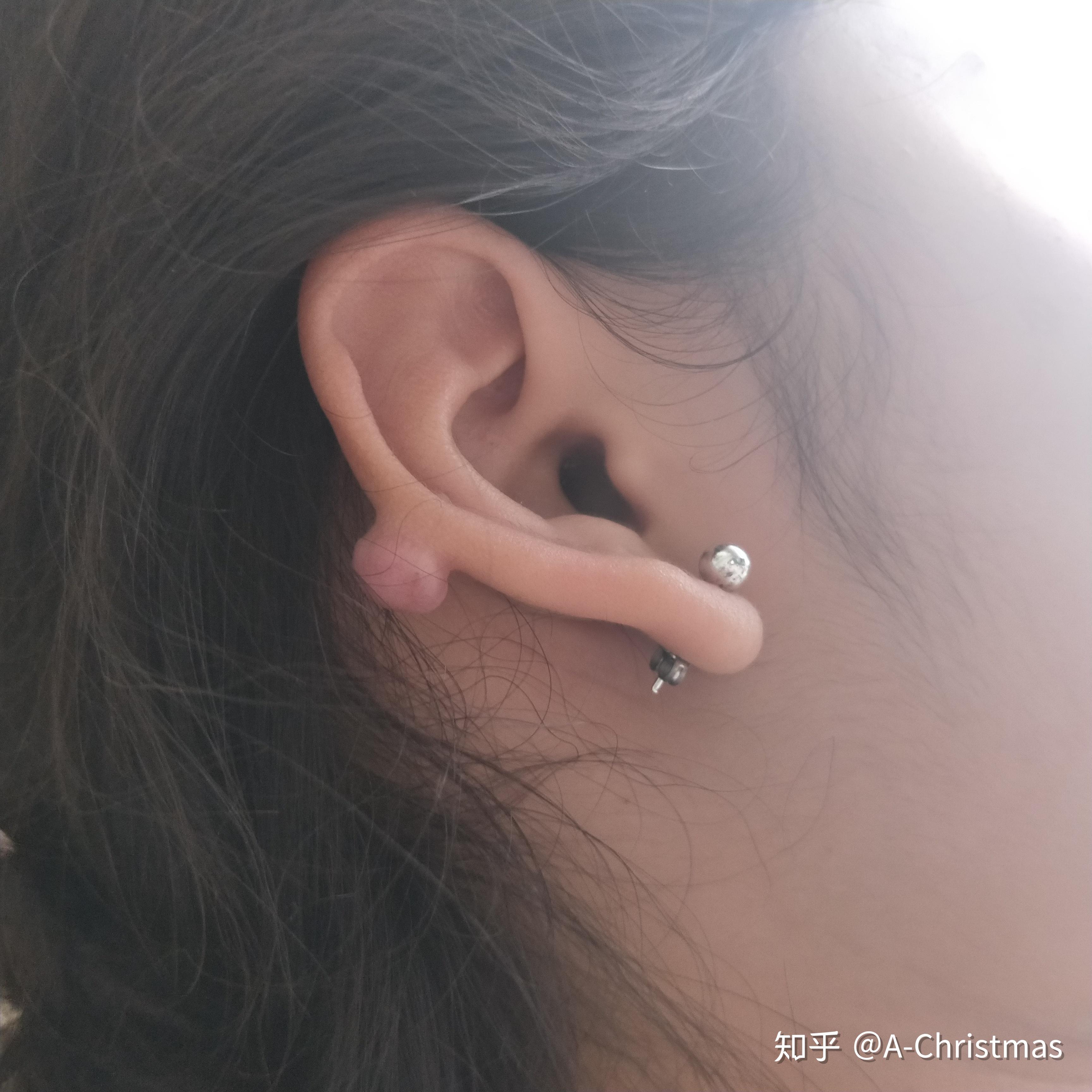 怎样解决耳朵打了耳洞后长了个肉球的糟糕状况啊