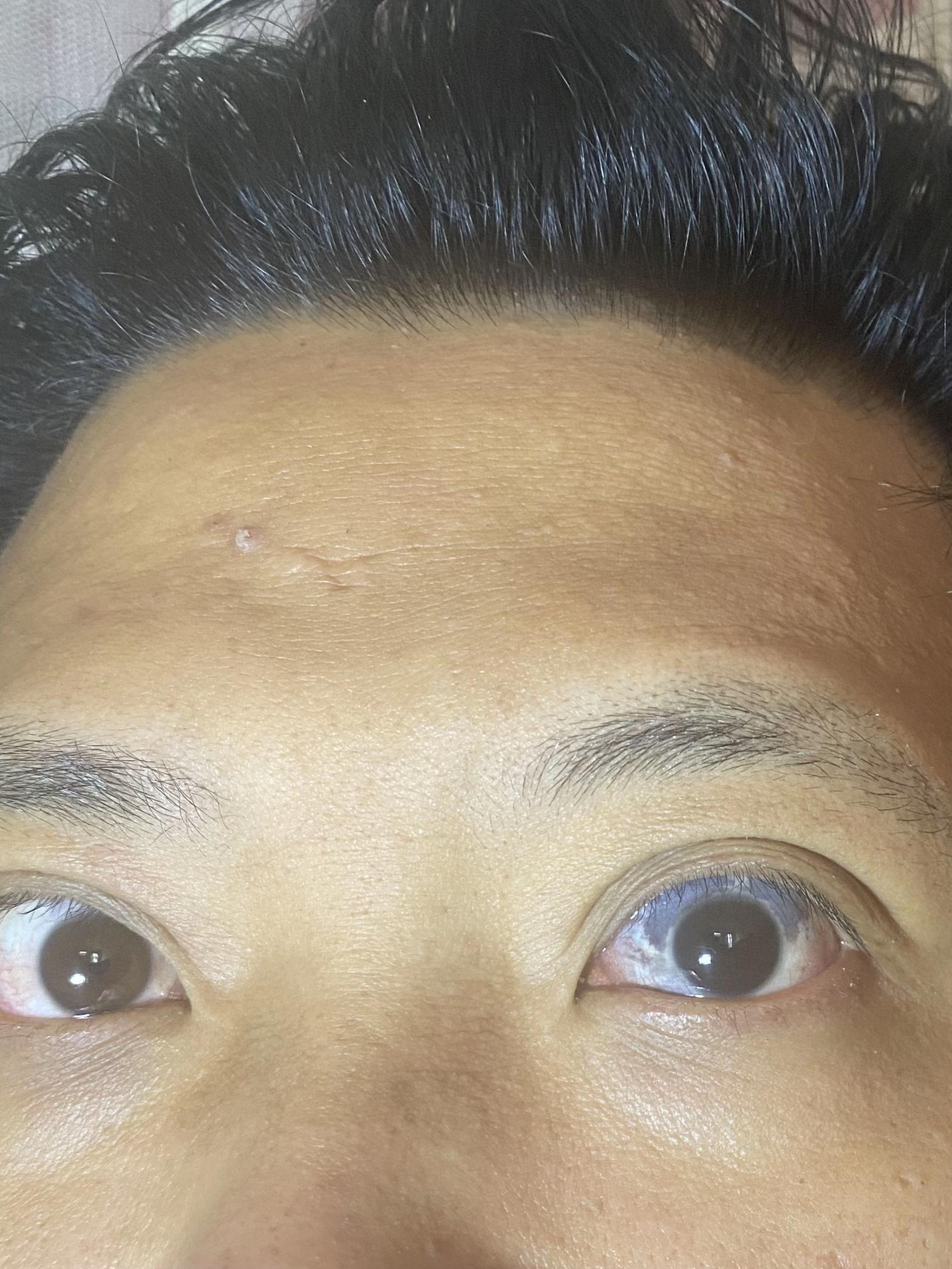 虹膜色素痣发作的原因是什么?