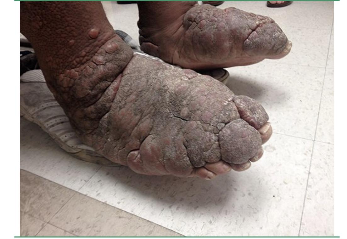 有没有甲亢出现黏液性水肿的? - 知乎