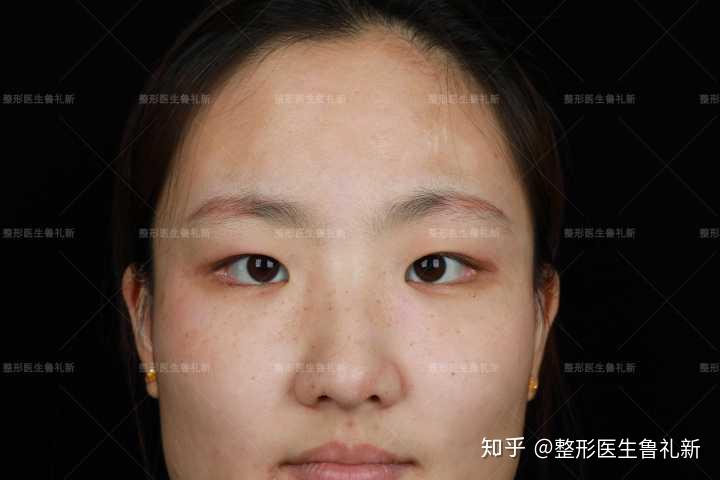 眼间距窄应该选什么风格双眼皮?建议开眼角吗?