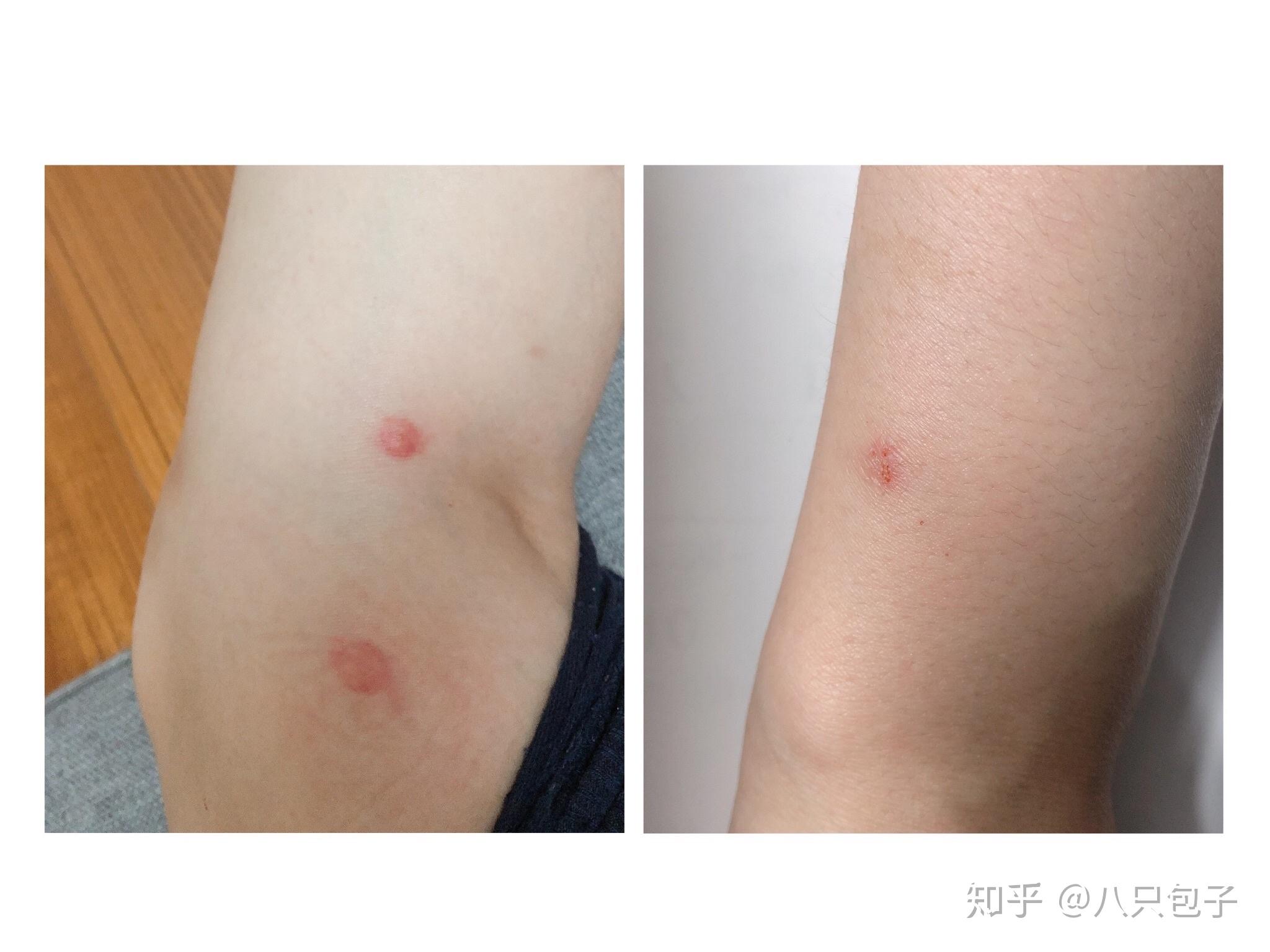 猫身上的跳蚤虫子咬人该怎样解决