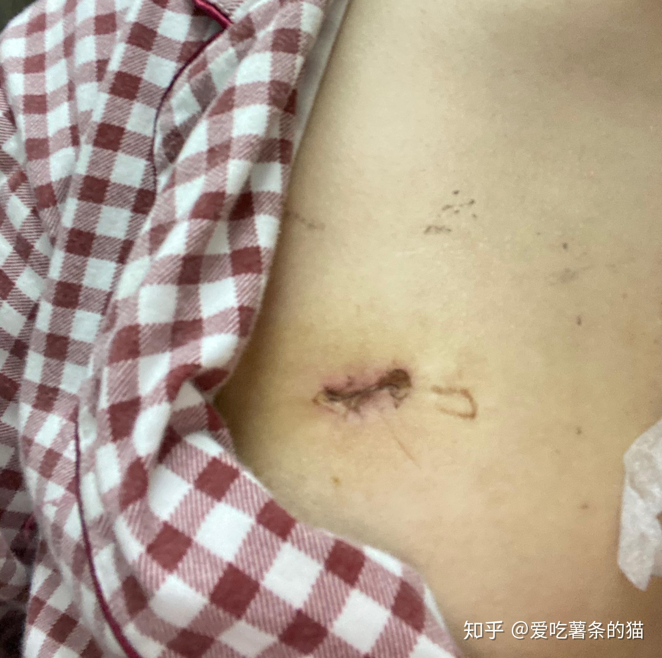 乳腺纤维瘤疤痕图片