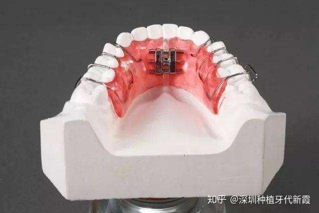 能否科普一下"骨开窗"? - 知乎