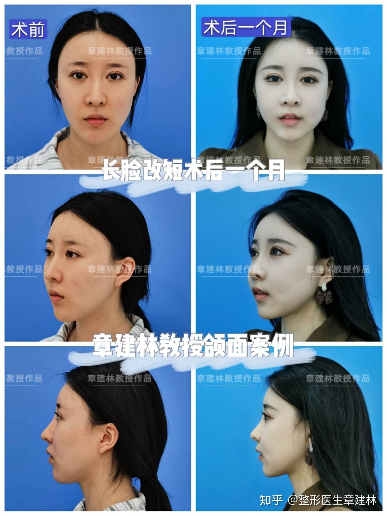 做正颌手术有助于改善脸长脸方吗? - 知乎