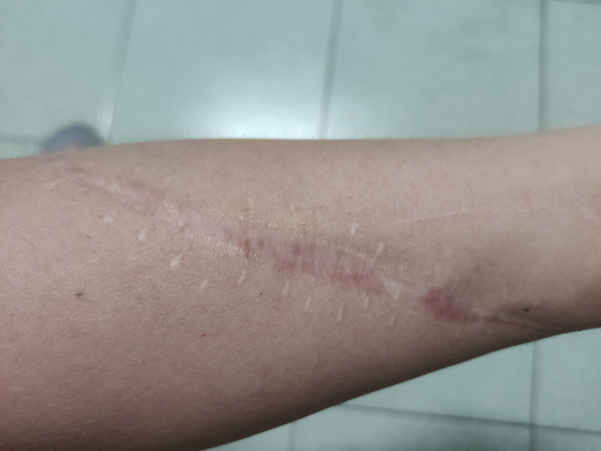 手臂有15cm左右切割伤会对健身造成影响吗? - 知乎