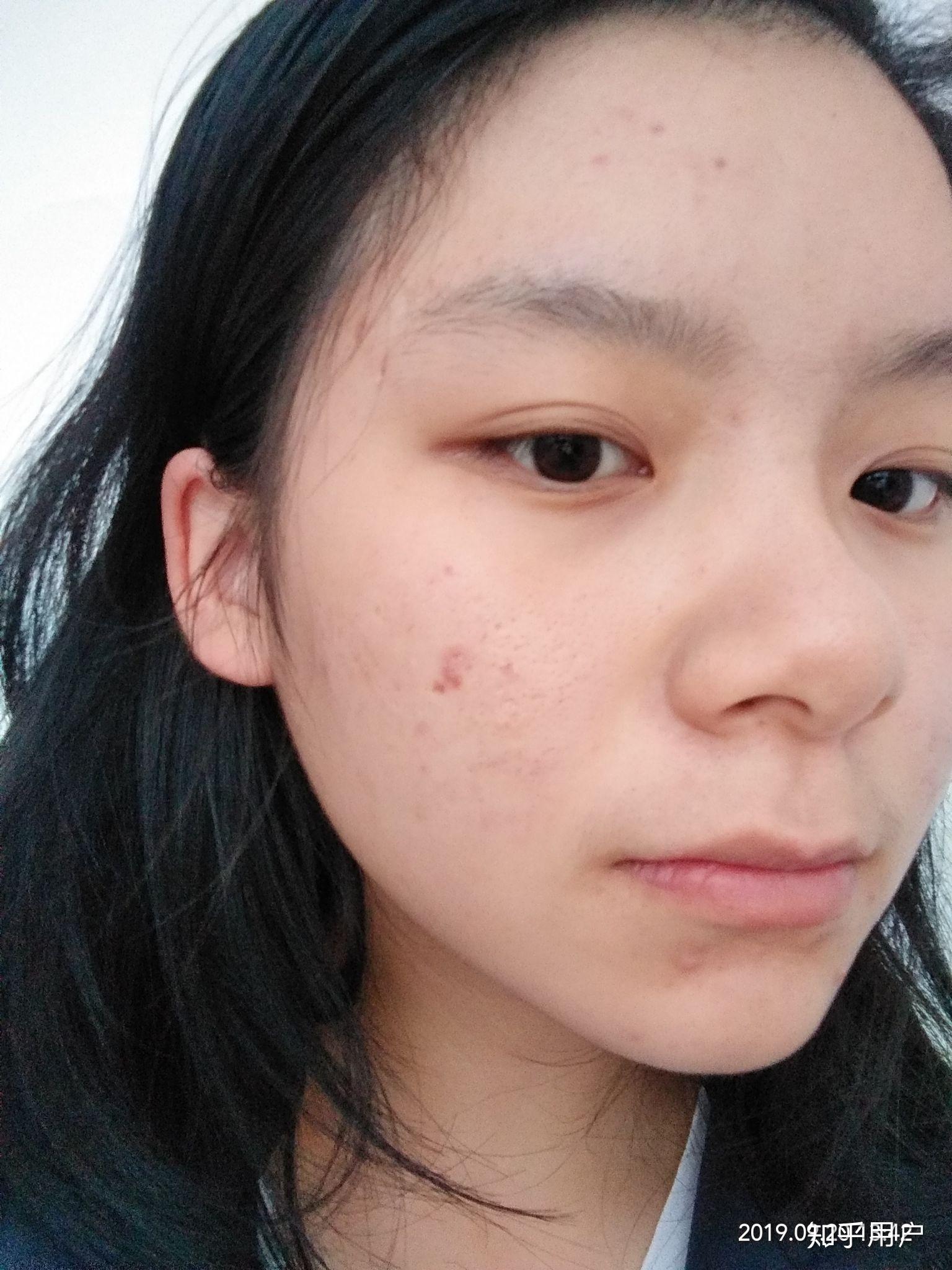 有没有长得好看但长痘痘的女生? - 知乎