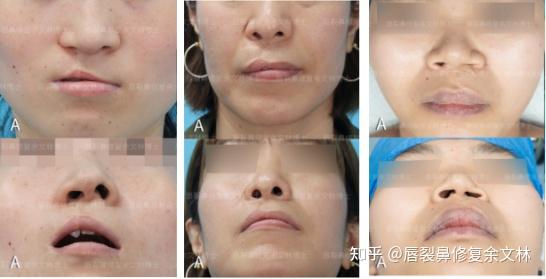 成年人做唇裂修复效果好吗? - 知乎
