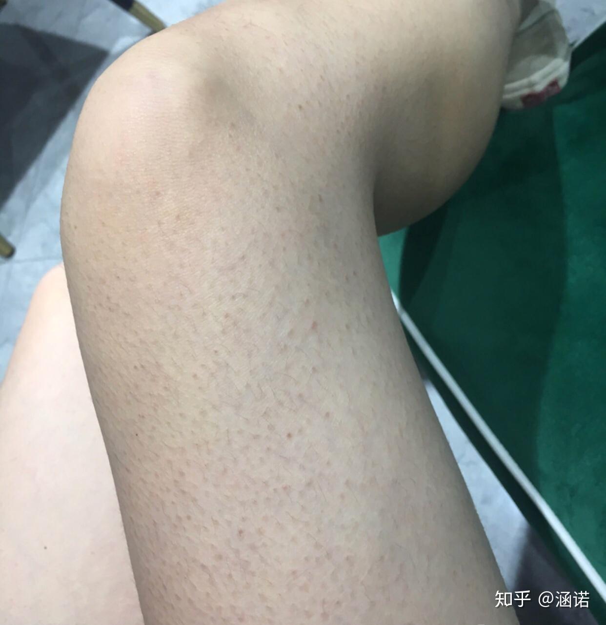 有鸡皮肤是什么体验