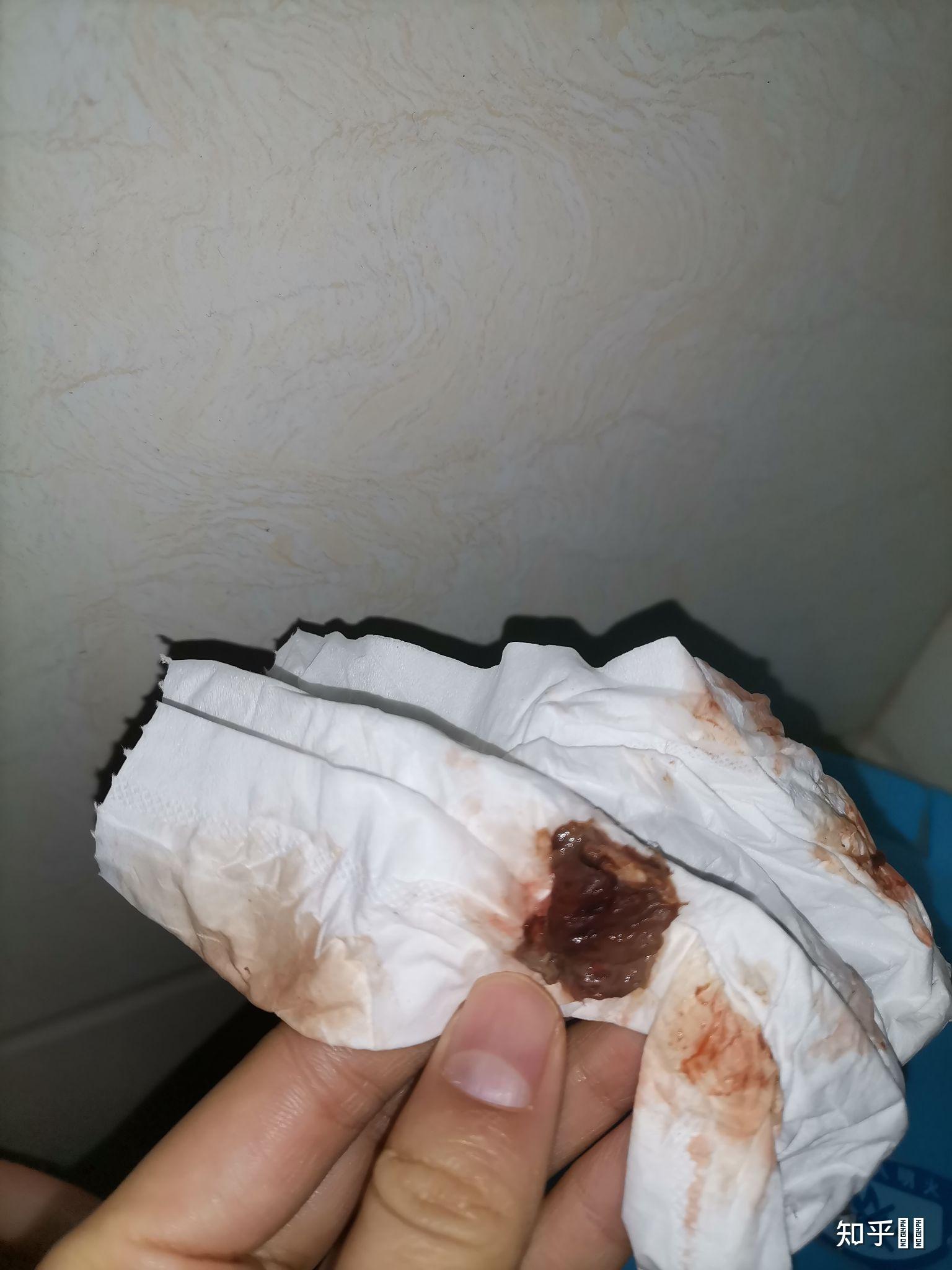 1厘米残留,医生开药吃,二十五天复查残留仍旧,已无流血,不想清宫!