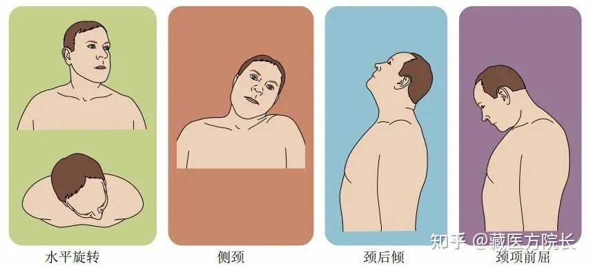 痉挛性斜颈有⑧种类型,你是哪一种? - 知乎