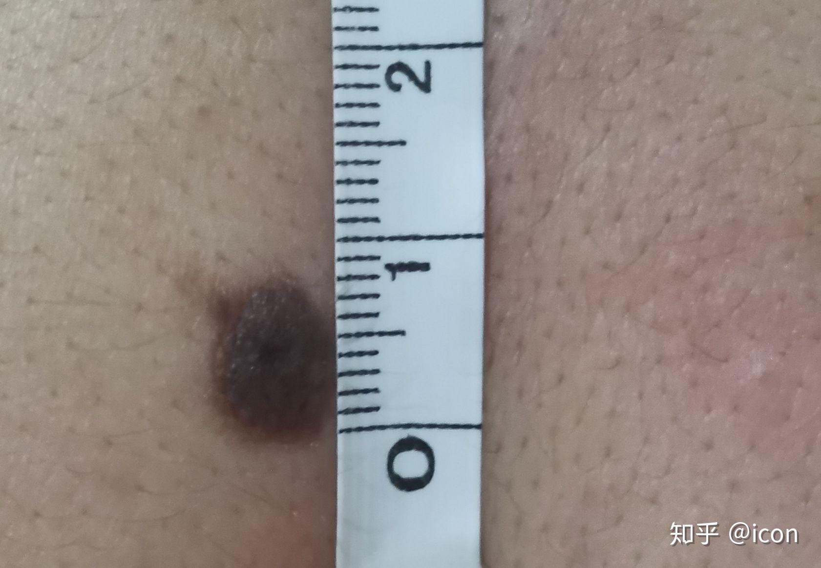 背上有颗超大的黑痣,我记得有扣过它,有没有可能长肿瘤或者癌症.