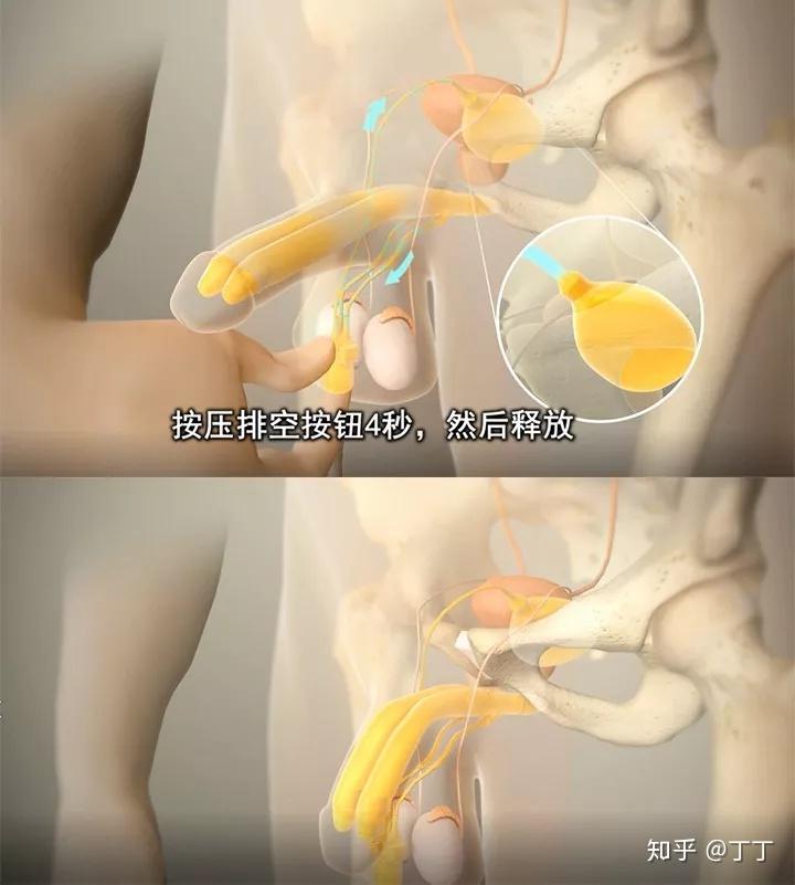 男性生殖器可以植入假体,随意软硬,这是真的还是假的?