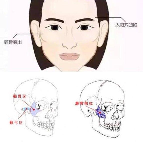 顴骨外擴顴骨高顴骨突出傻傻分不清楚