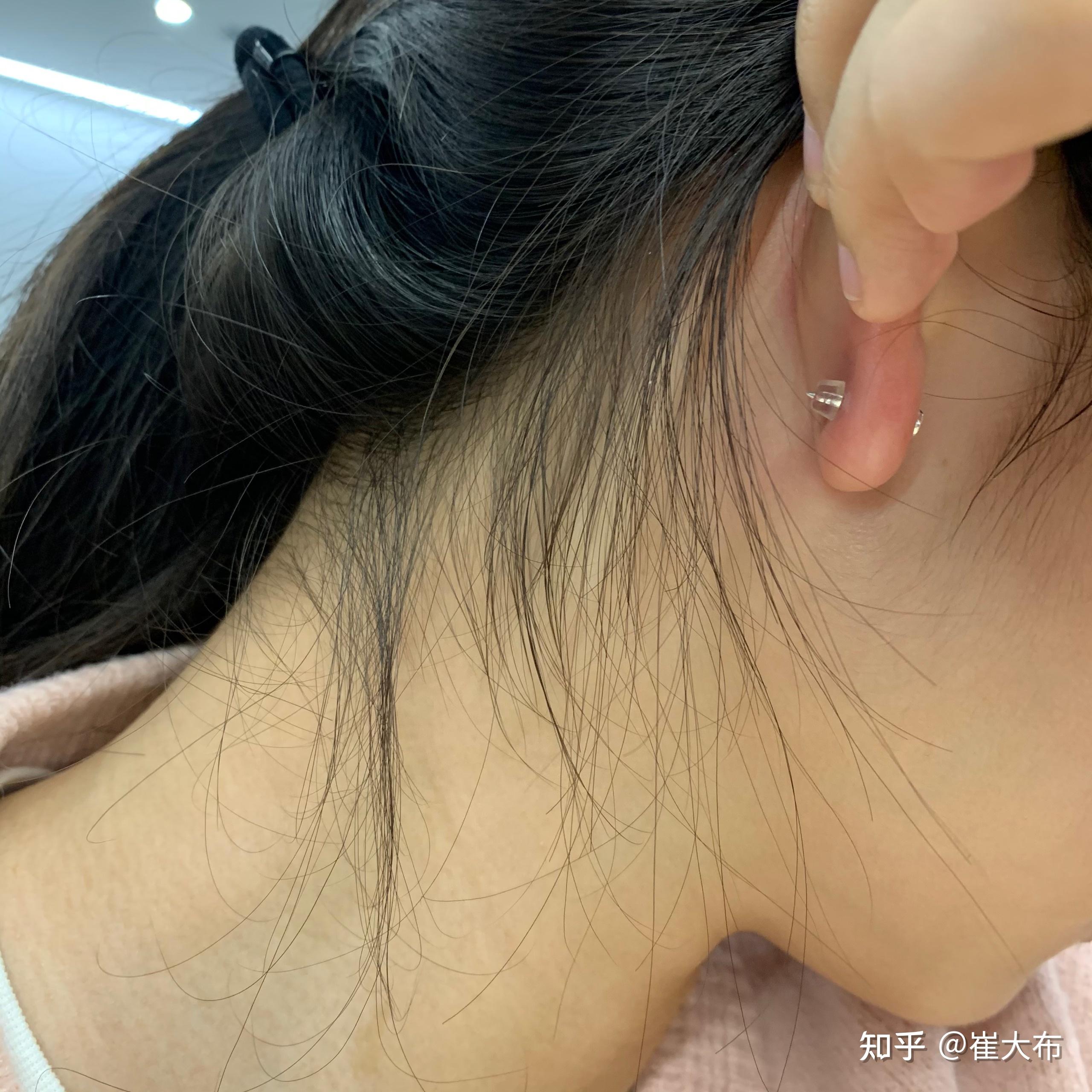 厚耳垂打耳洞是一种什么样的体验,会很疼吗? 
