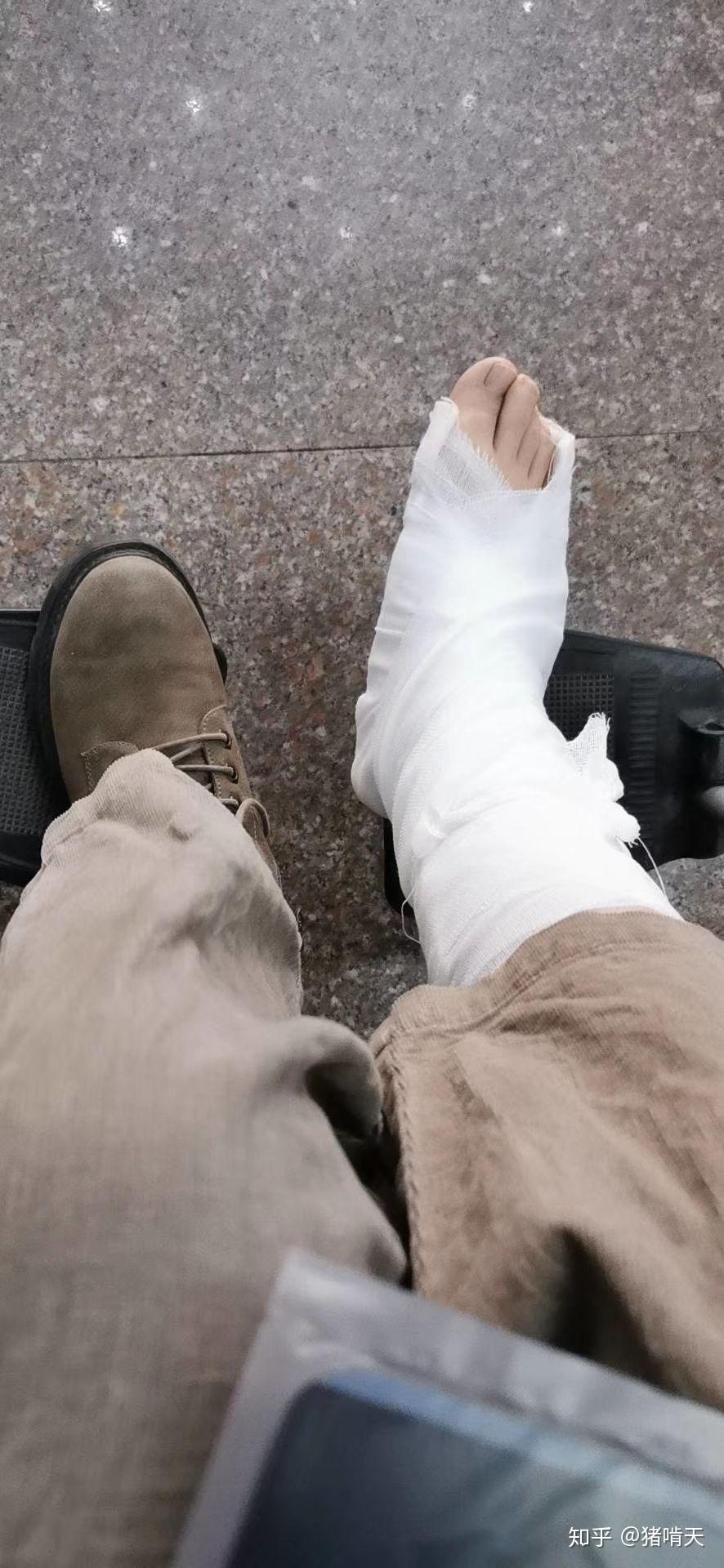 崴一脚骨折的可能性大么