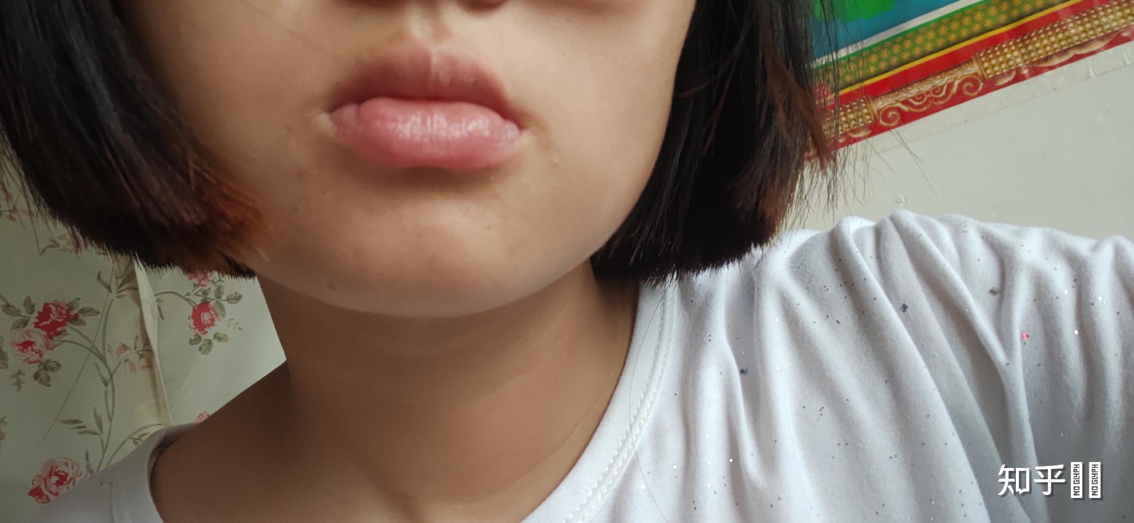 下唇外翻怎么办