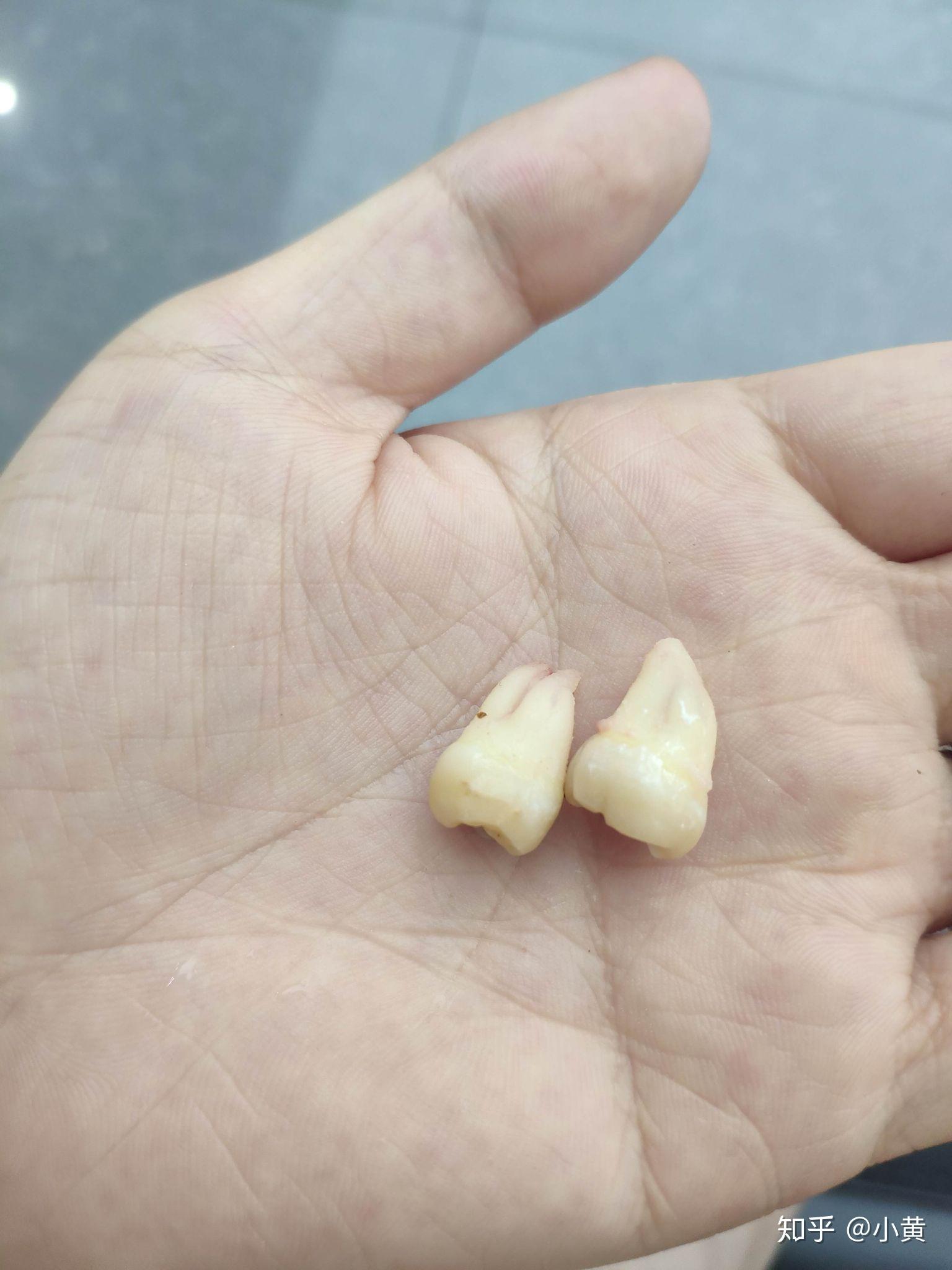 智齿长得很好(即正位不痛)是什么体验? - 知乎