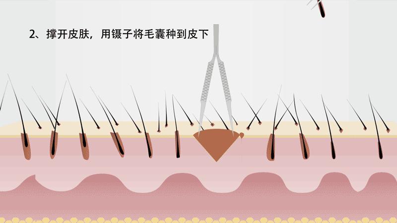 微针植发技术为什么这么贵?跟传统植发有何区别? - 知乎