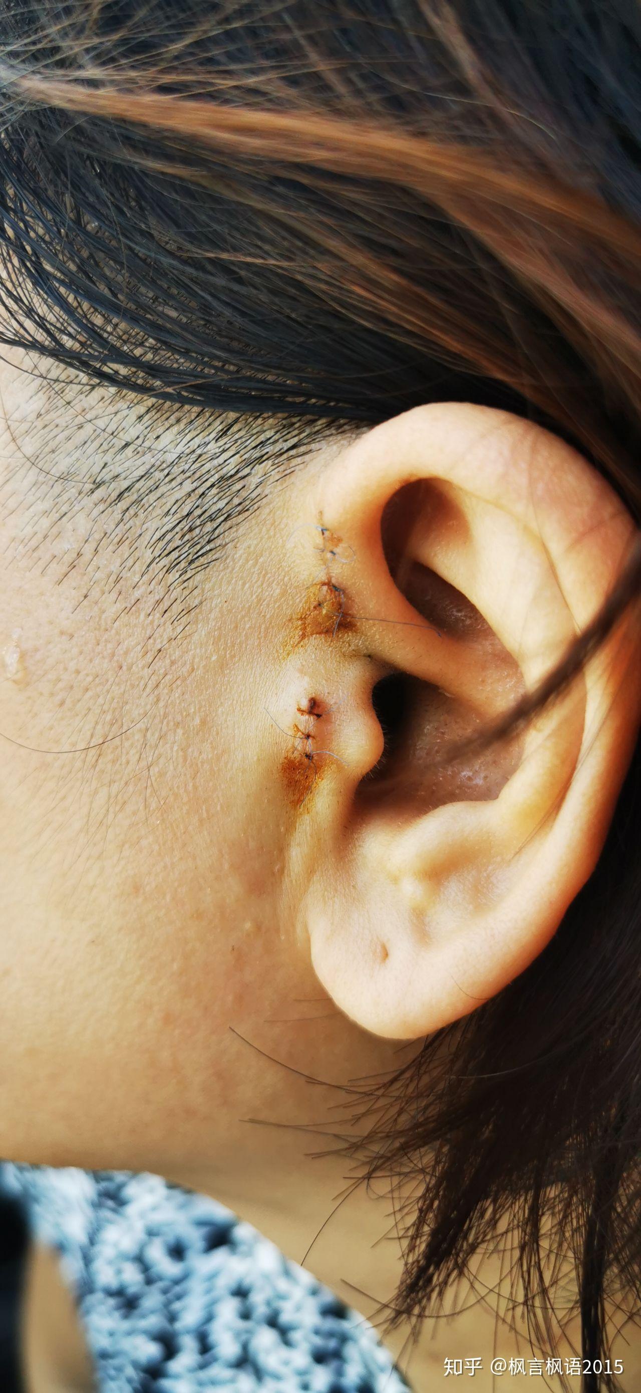 先天性耳前瘘管，发炎后需手术治疗_先天性耳前瘘管 - 好大夫在线