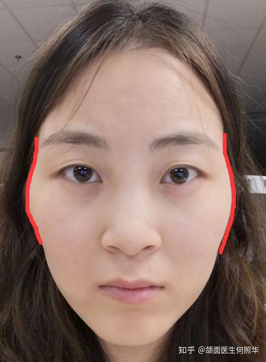 菱形脸高颧骨应该怎样改造呀? - 知乎